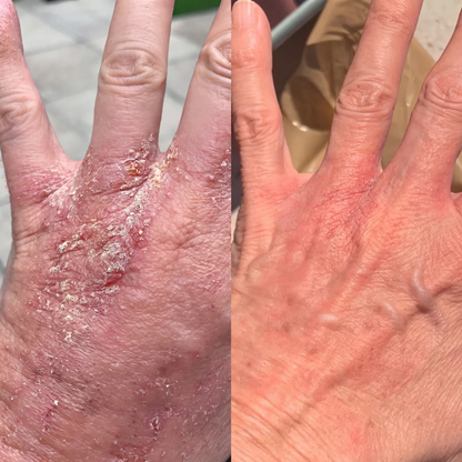 Eczema Relief Cream - Oatmeal & Beeswax